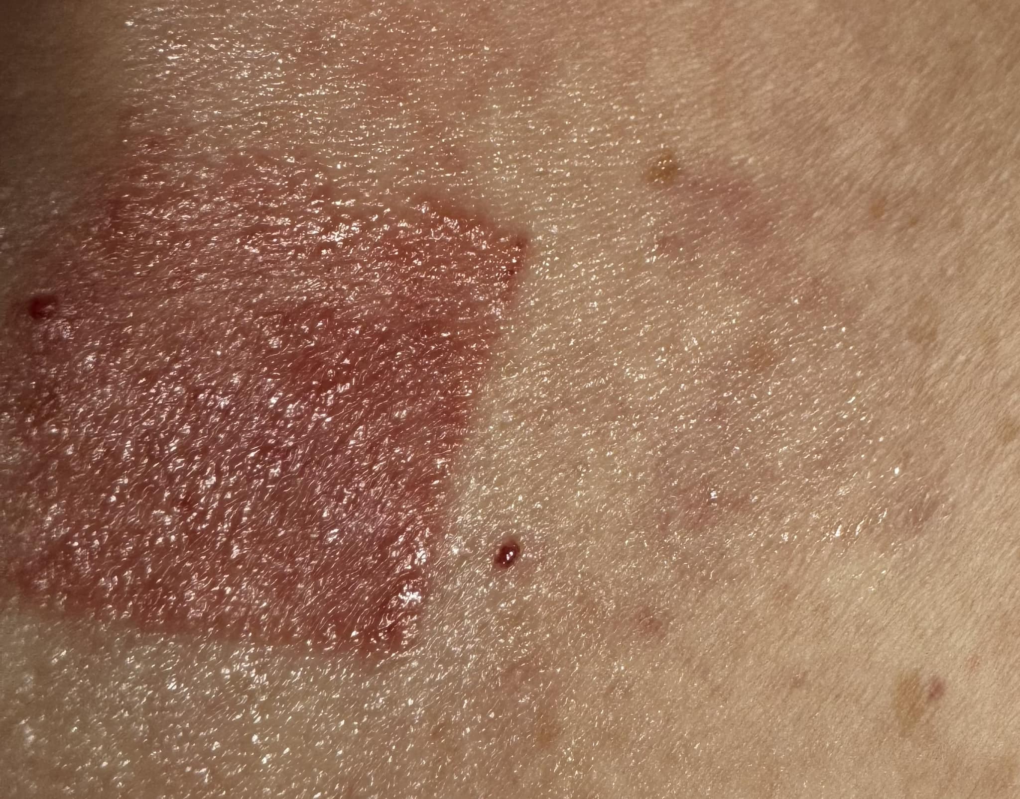 Deirdre's angry patch reaction, showing a reddened skin rectangle. To its right, a very faint shadow of the same size that's two weeks older.